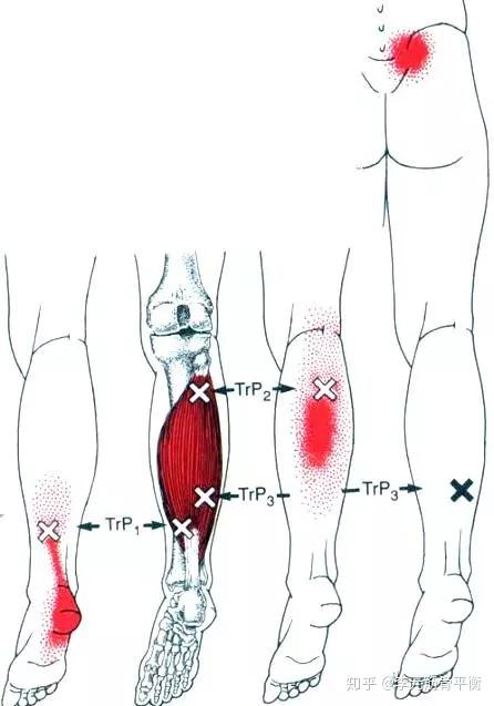 足夠完美之足底筋膜炎5完美小腿之小腿三頭肌
