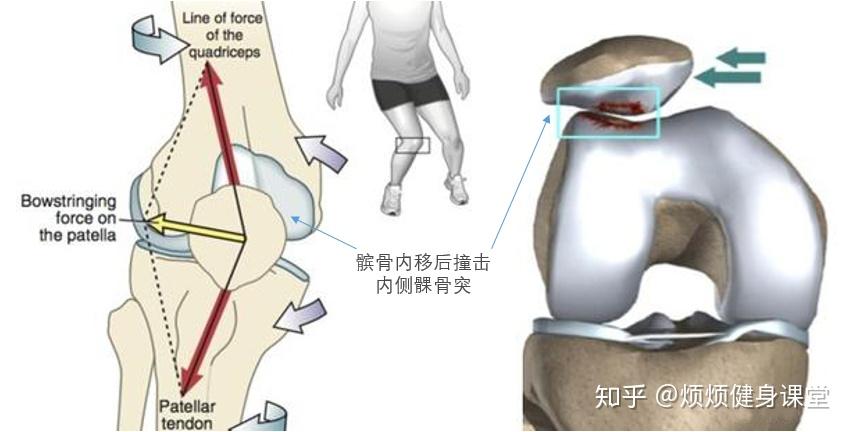 膝关节内侧的胫侧副韧带受力拉长而变得松弛,同时在该不良姿势下,膝盖