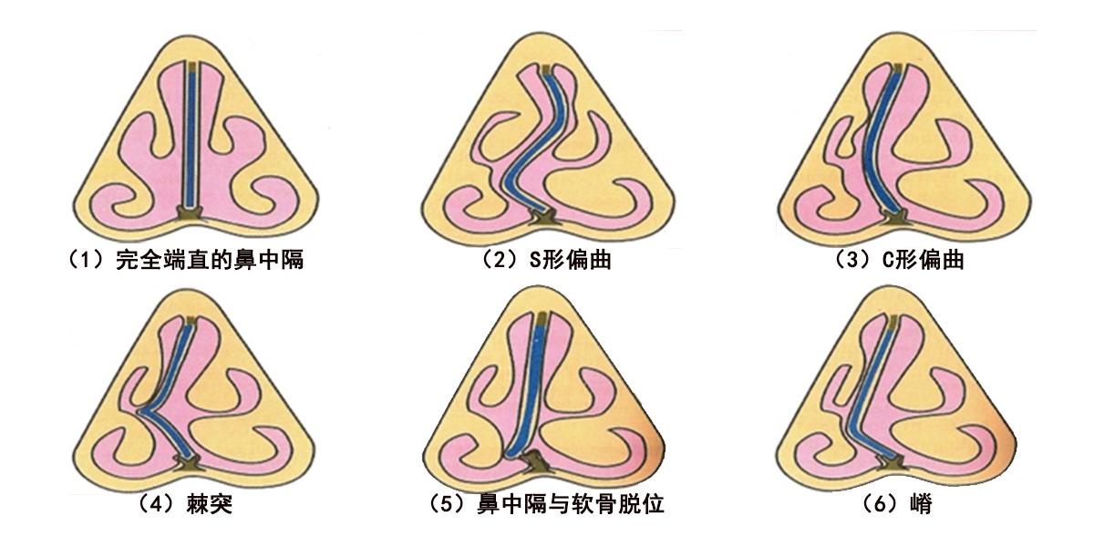 关于鼻中隔偏曲手术与保守治疗选择? - 知乎