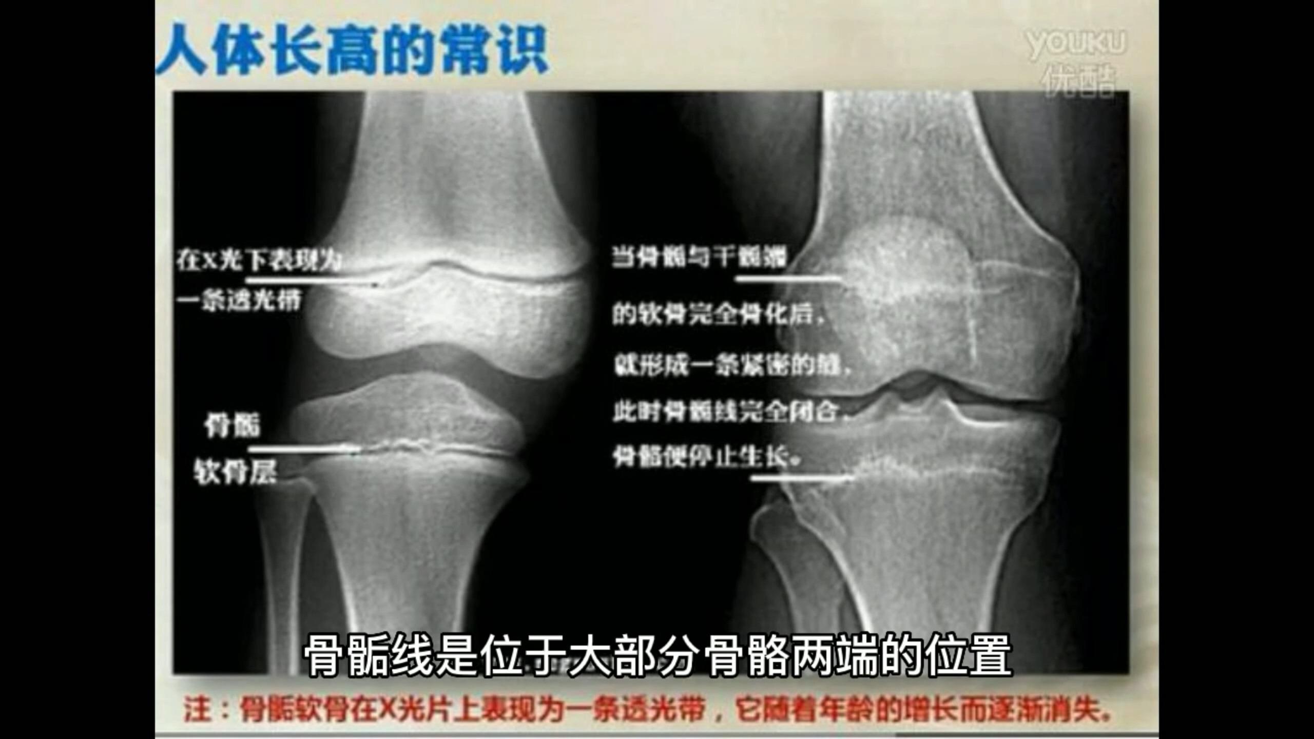 骨骺线是什么?如何判断骨骺线是否闭合？ - 知乎
