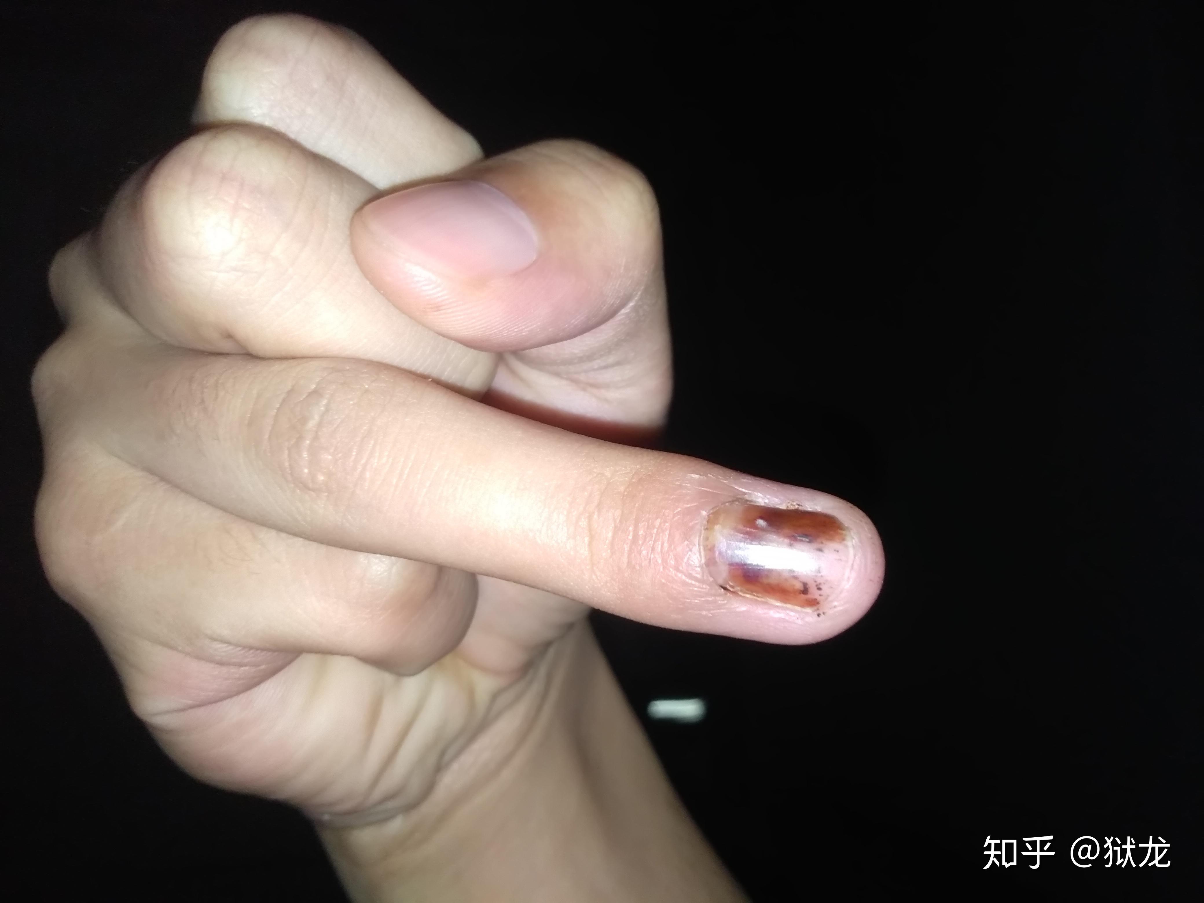 手指甲被夹到,过了一段时间,有黑色的淤血,怎么处理? 