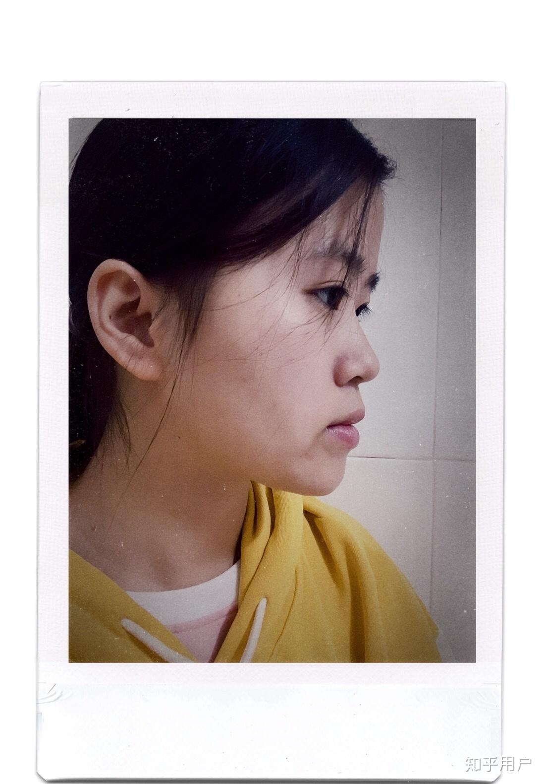 牙齿地包天兜齿是怎样的一种体验