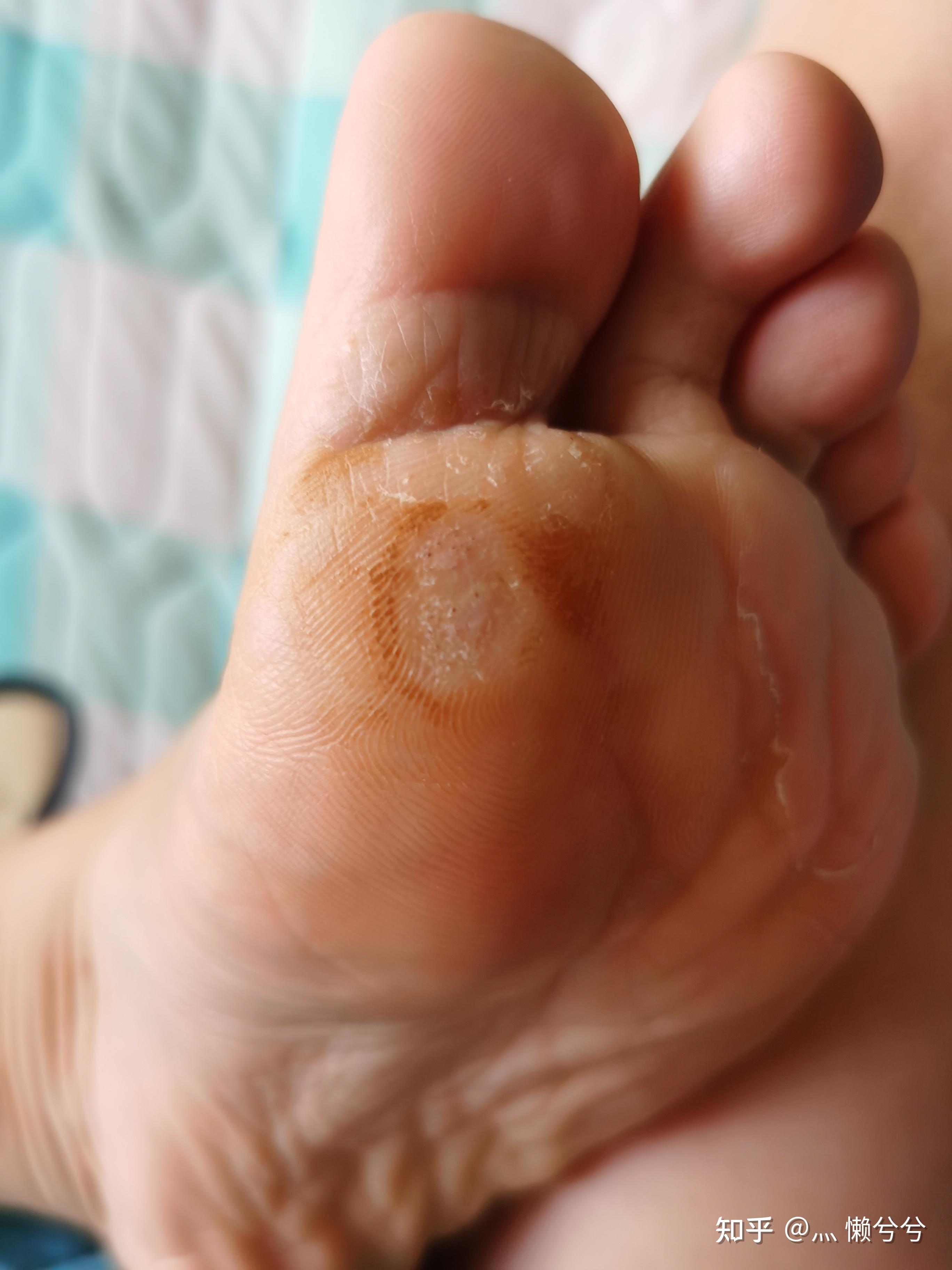 跖疣怎么样才能彻底根治