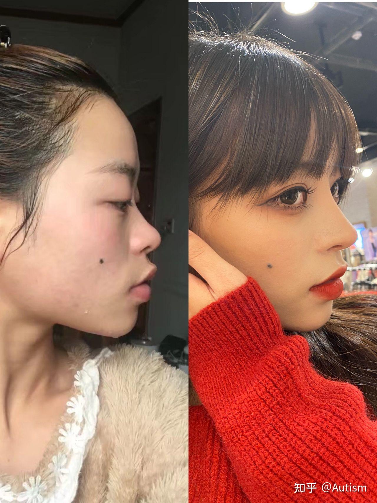 2人赞同了该文章 个人情况初鼻 问题鼻头大且肥没形状没山根鼻