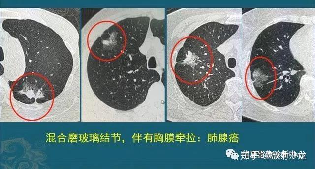 正常肺对比肺癌ct图片图片