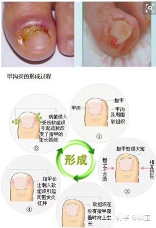 什么是化脓性甲沟炎 - 知乎