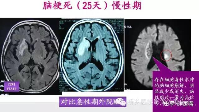 脑梗核磁图片解说图图片