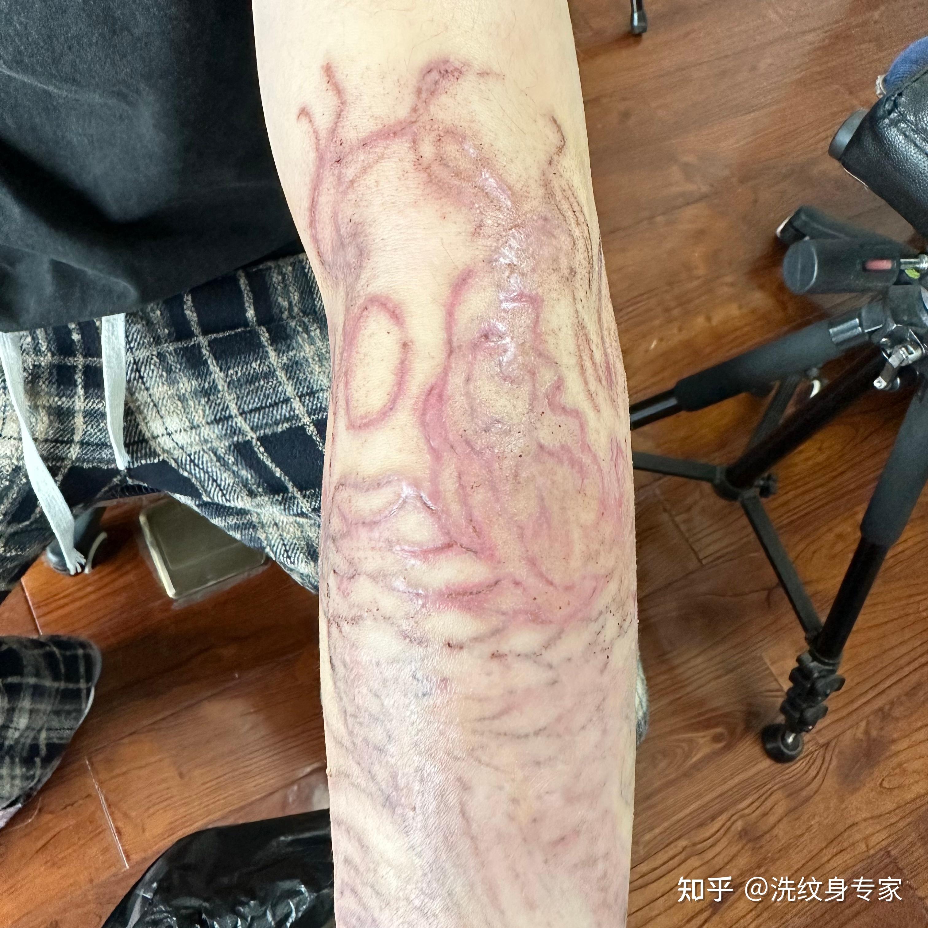 请问一下,深圳有专业洗纹身的吗? - 知乎