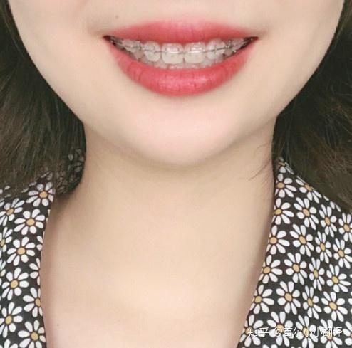 上海陶瓷半隐形矫正带牙套过程图