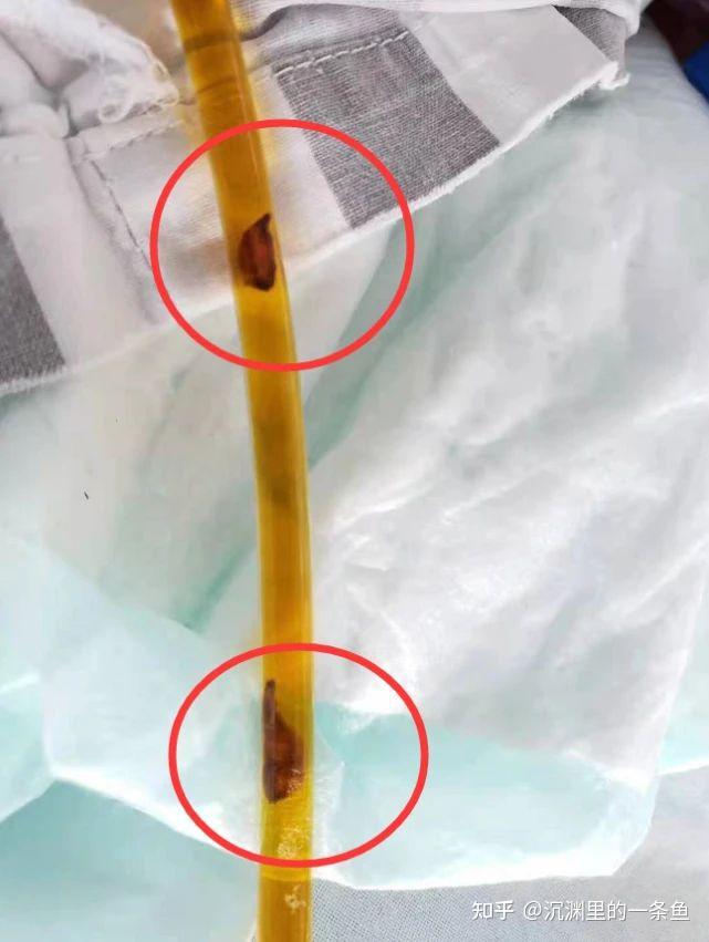 陈登吐出来的虫子是什么虫?