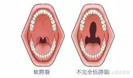 兔唇,医学上称之为先天性唇裂,严重的唇裂还伴随不同程度的腭裂,牙槽