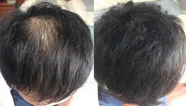 脂溢性脱发怎么治疗效果好治疗脂溢性脱发的关键在这里