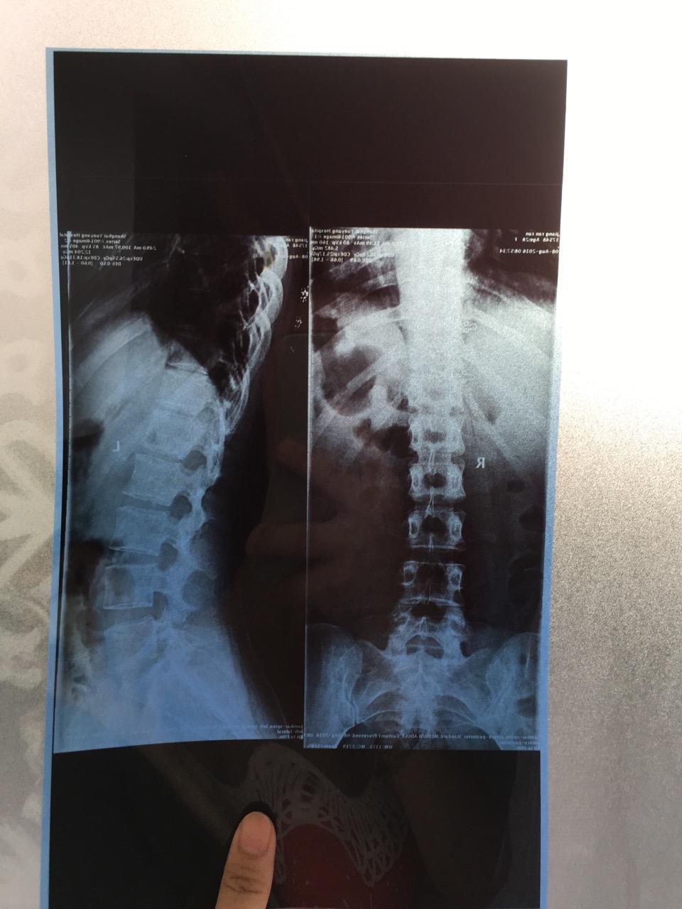 腰椎旋转该如何锻炼恢复