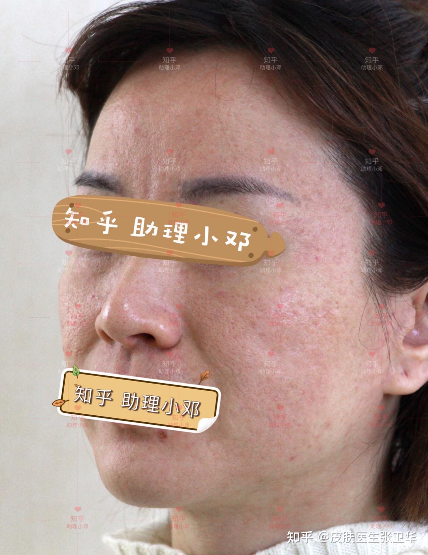 厢车型冰锥型痘坑做了两组激光后的即时反馈对比来了