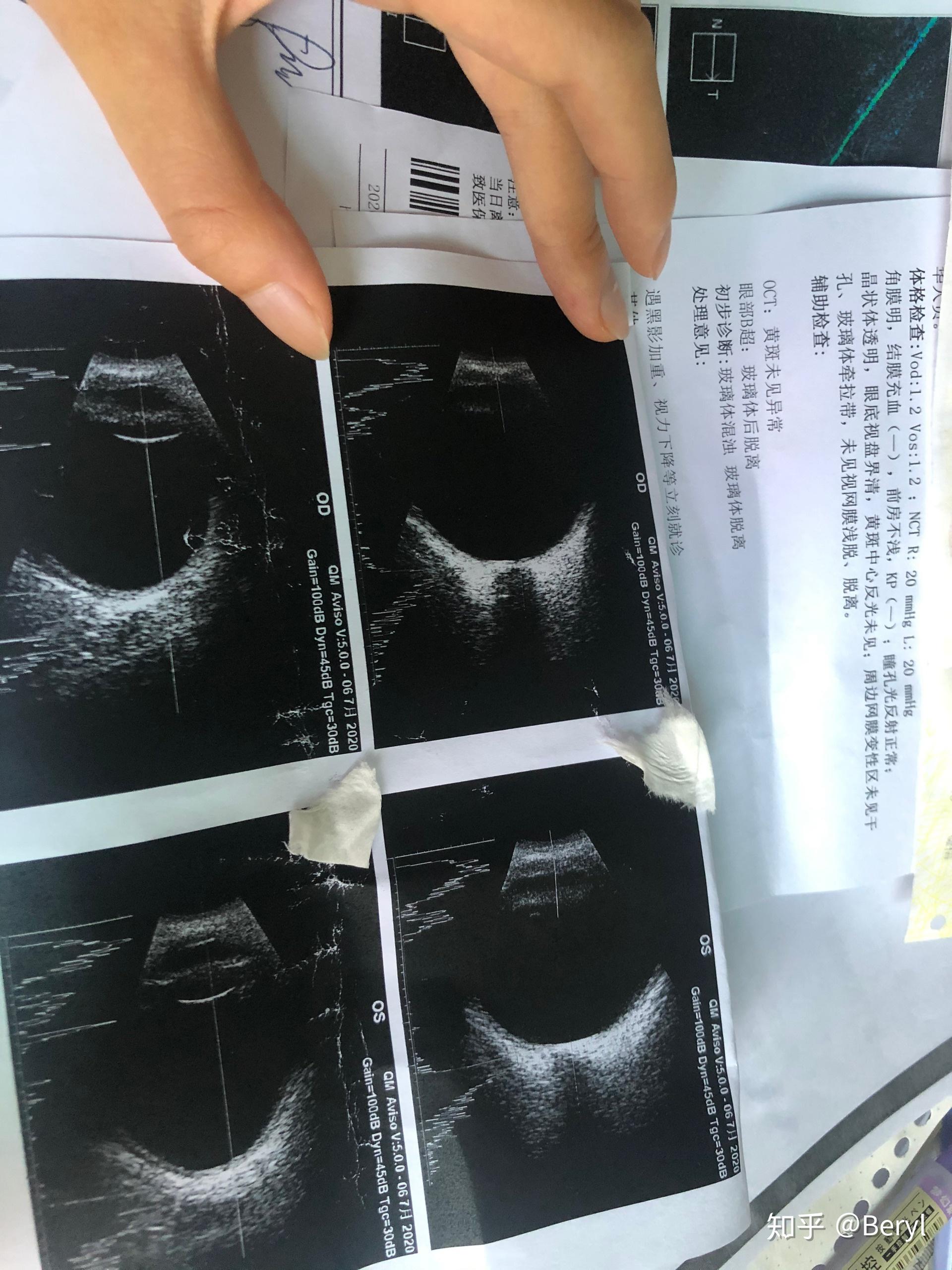 玻璃体后脱离 - 知乎