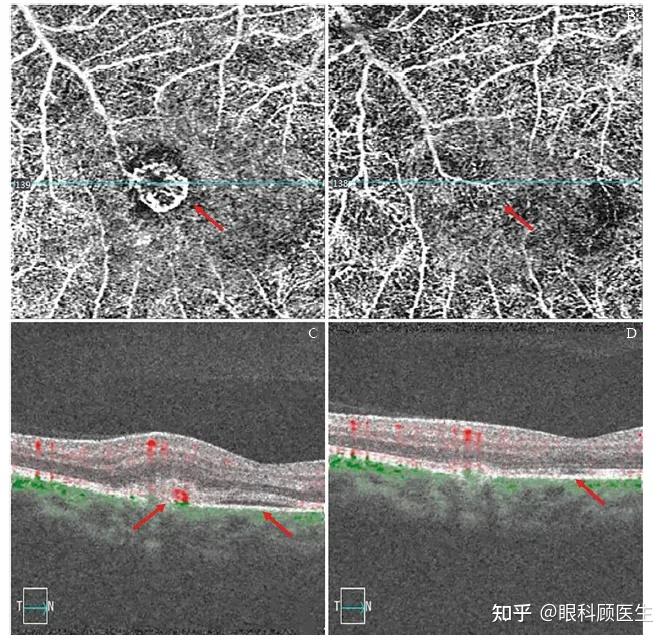 怎么判断和治疗中渗病