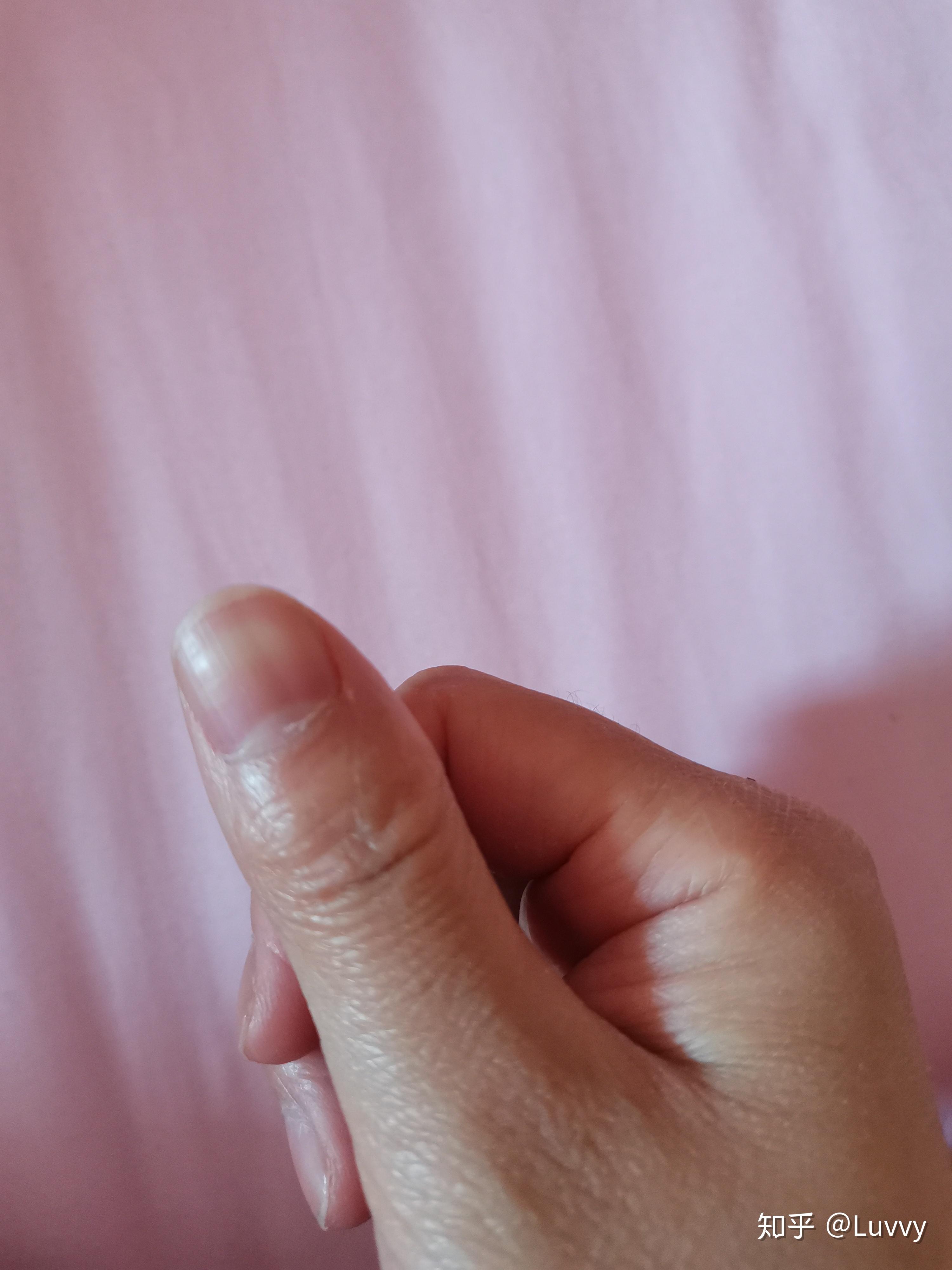 大拇指指甲竖纹图片