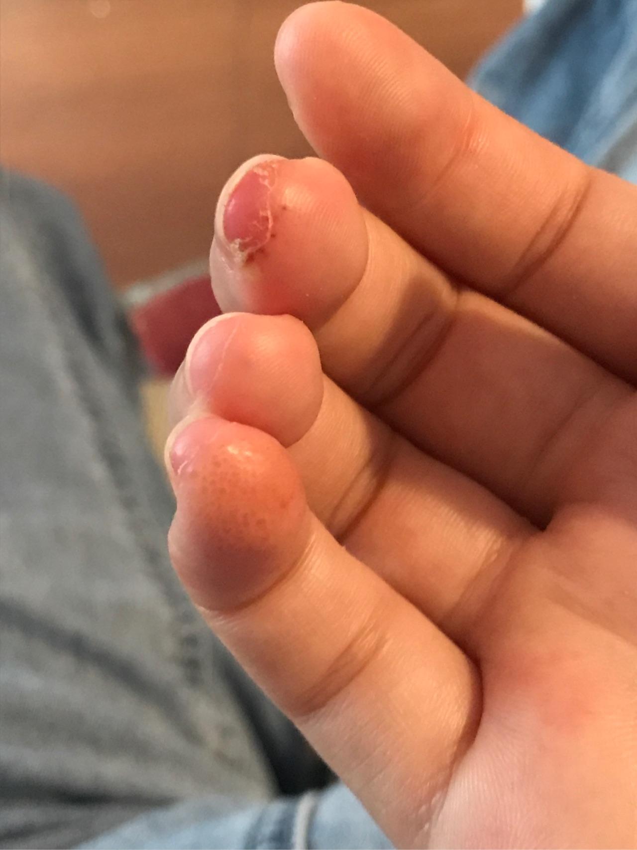 最近手上突然冒出这种皮下小水泡,求助!