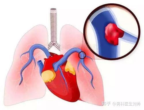 陰莖異常勃起的手術步驟及要點