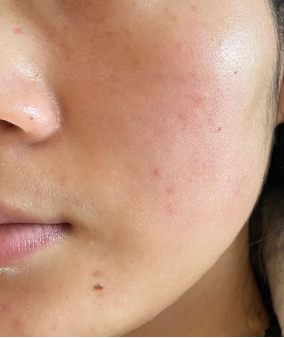 谁再说角质层不可逆,头给你打歪!