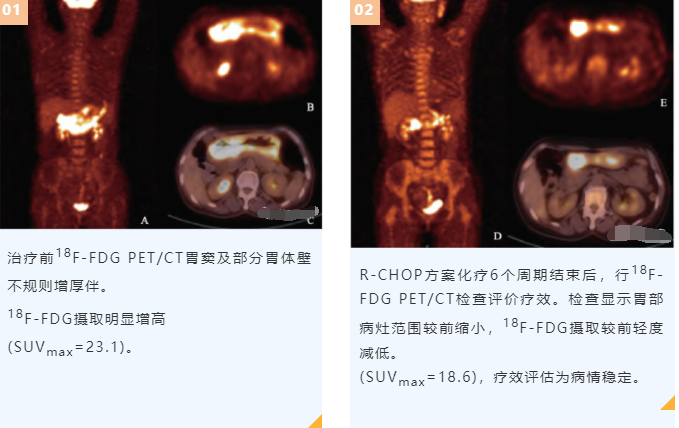 胃MALT淋巴瘤的PET/CT诊断应用 - 知乎