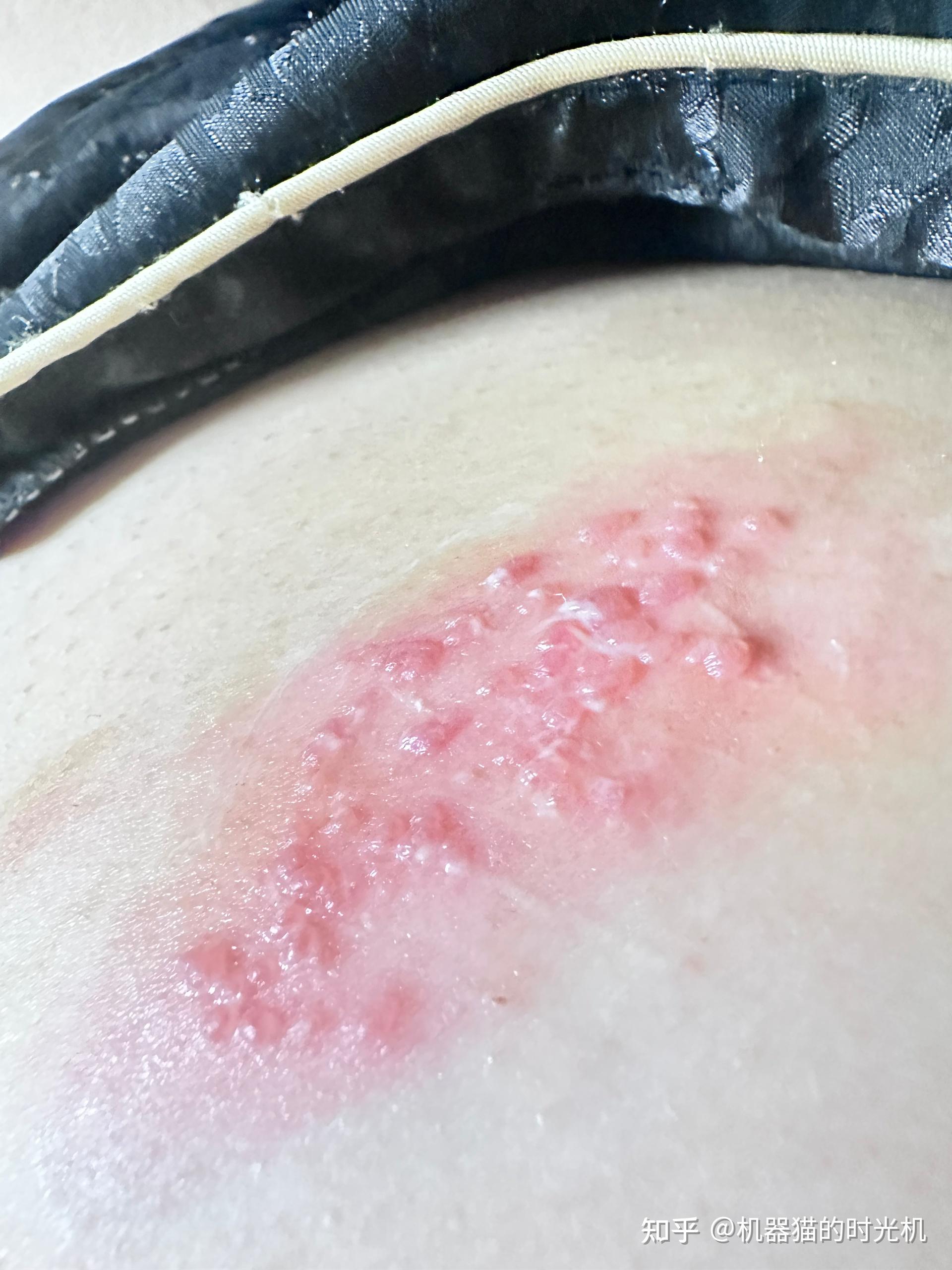 据说带状疱疹蛇缠腰长满身体一圈就会死是真的吗