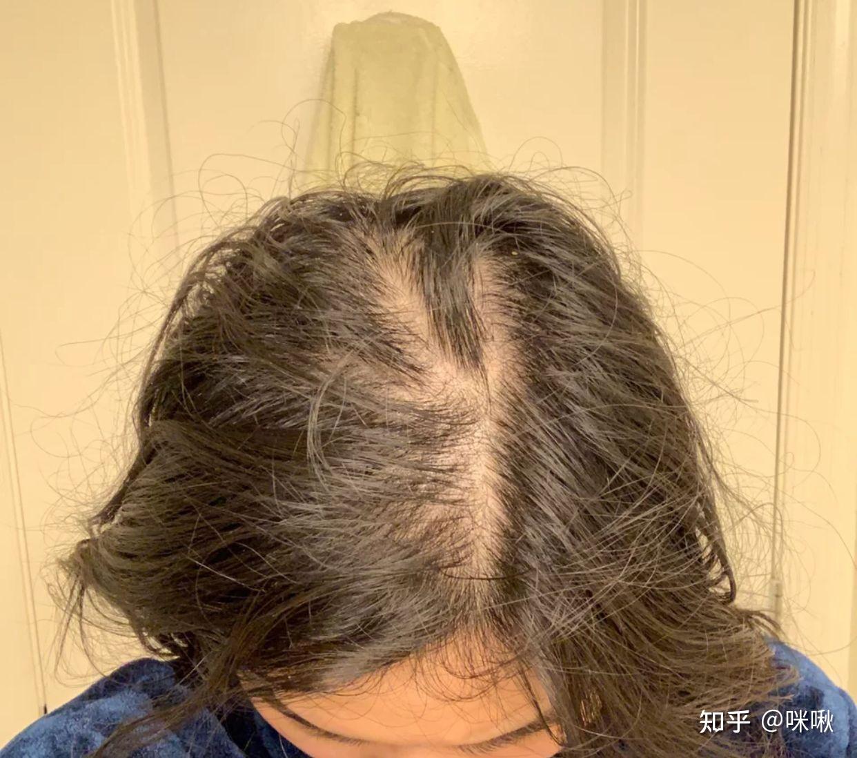 油性发质,而且掉头发,一般一天洗一次头发,用什么洗发水比较好?