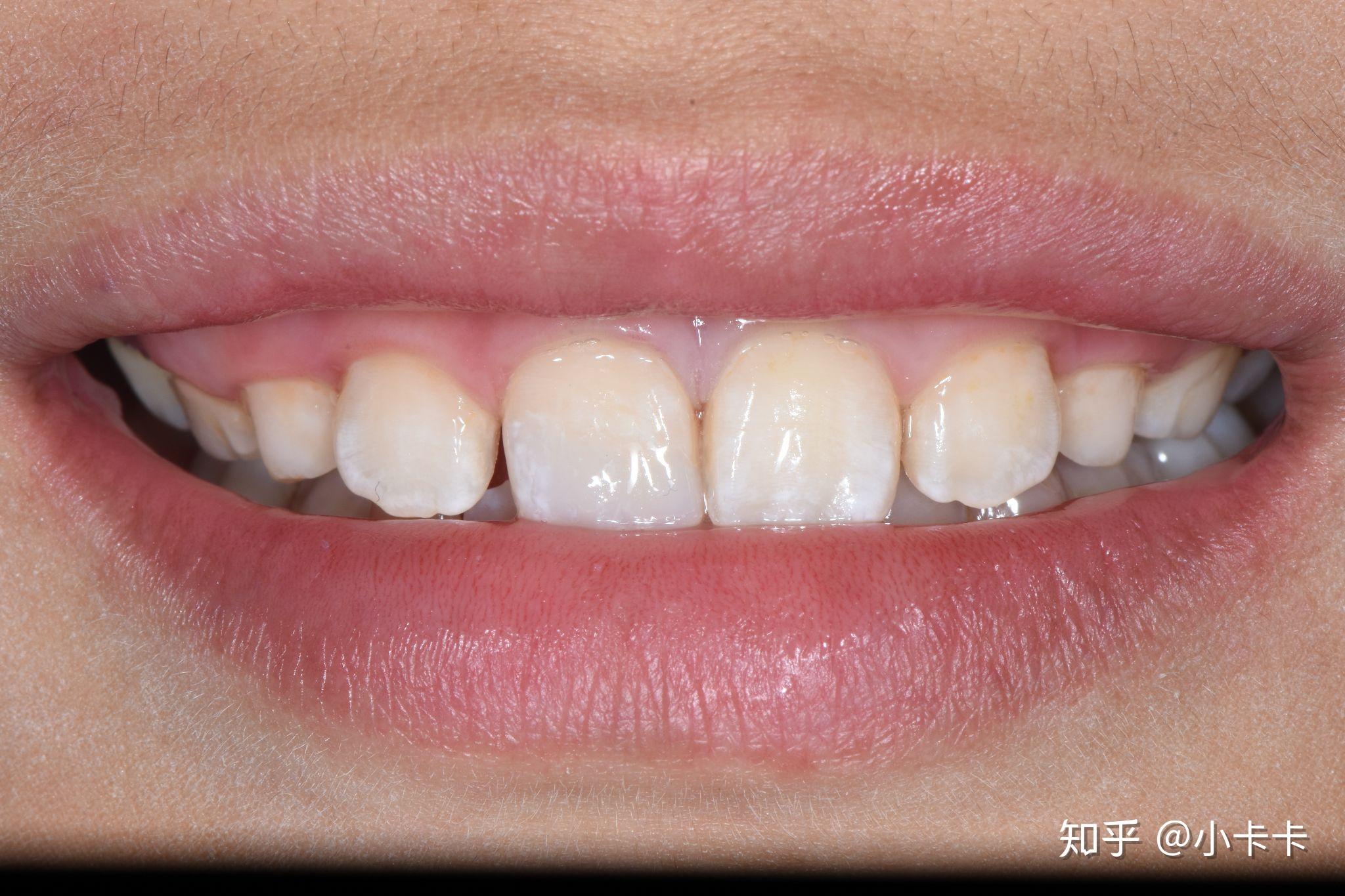 前牙外伤一周美塑树脂补牙一例