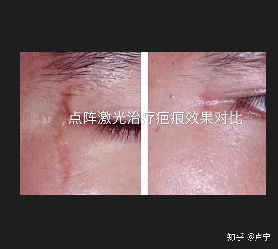 姚先生下颌疤痕疙瘩治疗后效果显著_北京疤痕医院_瘢痕修复_疤痕治疗_北京疤康医院【官】