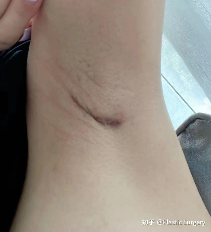 深圳姐妹做曼托圆形250高凸假体隆胸 - 知乎