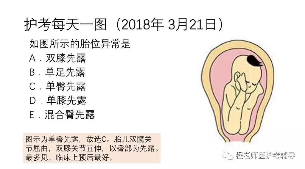 图4臀先露:是最常见的异常胎位,约占妊娠足月分娩总数的3%～4%.