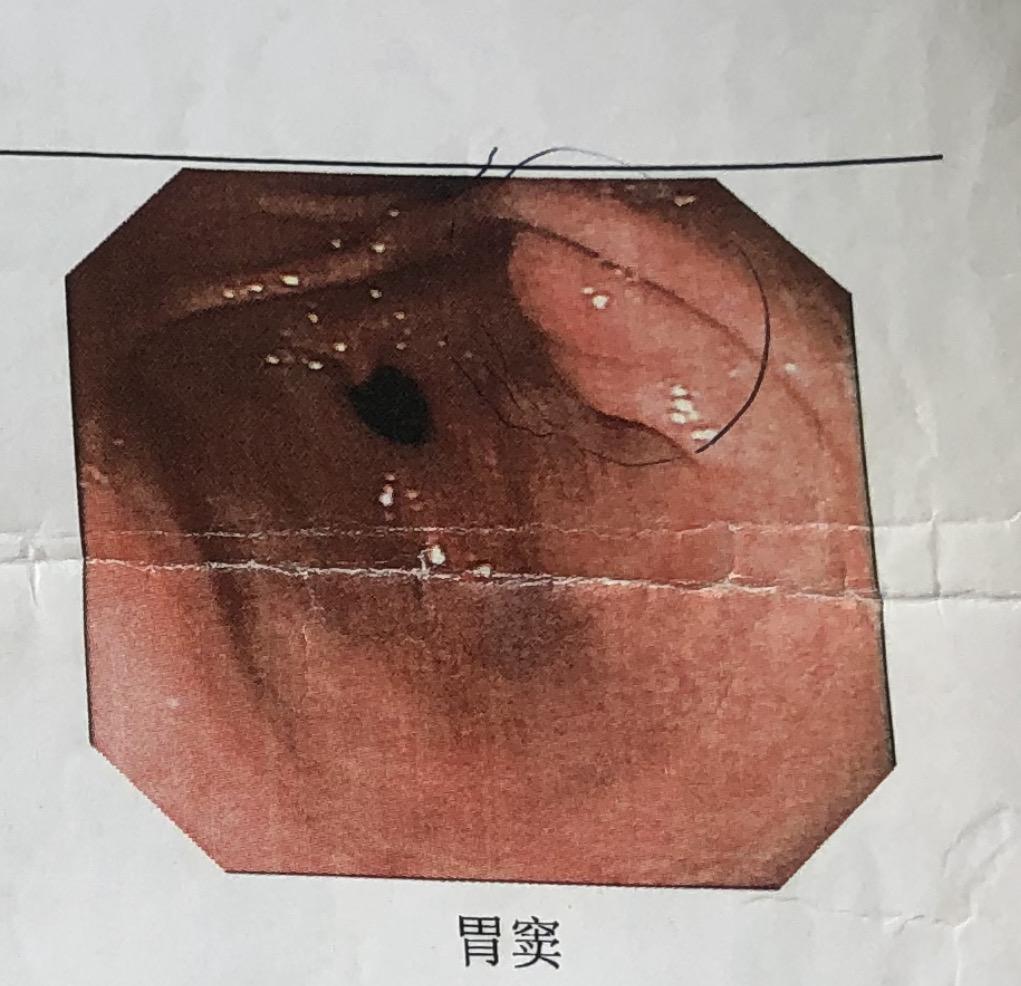 异位胰腺普通胃镜看到的是什么样子的