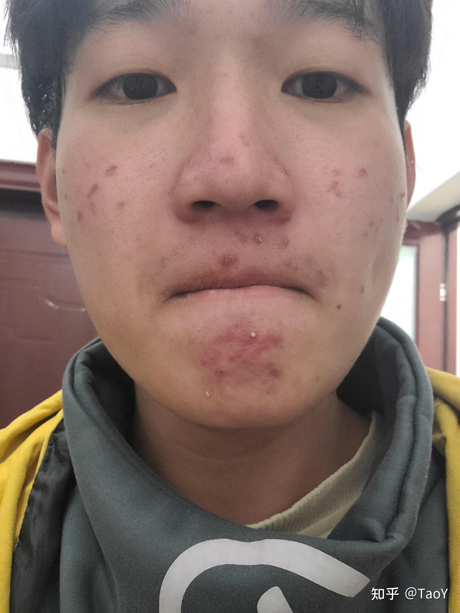 鼻子上凸起的增生痘疤怎么去除