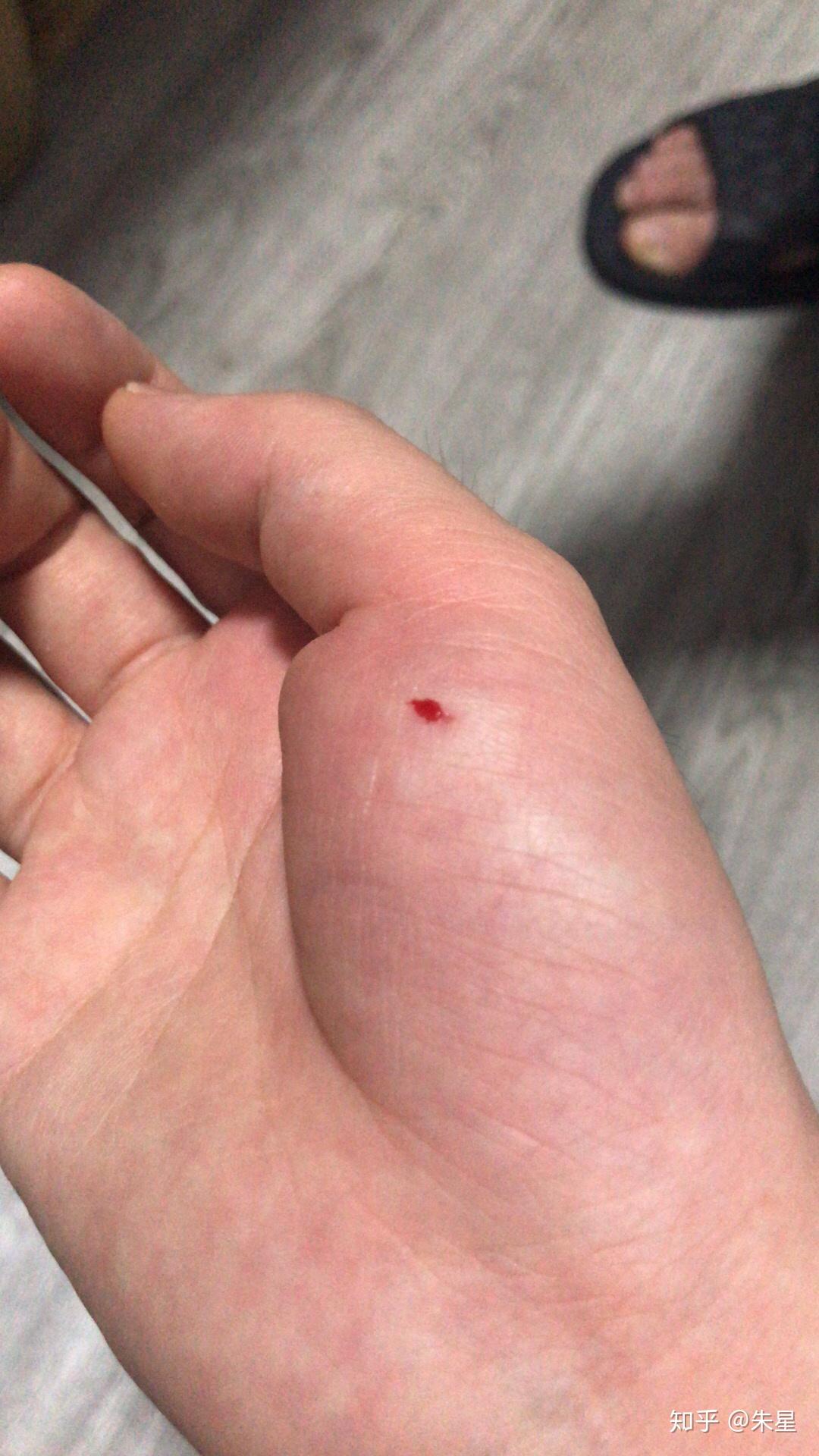 被马蜂蛰了怎么办