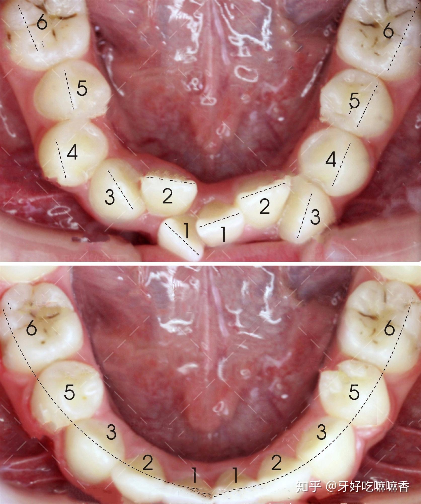 牙齿上下排的正确位置图片