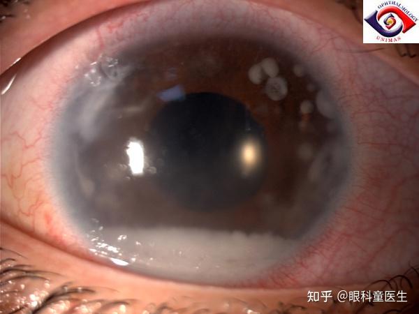视网膜母细胞瘤 眼睛图片