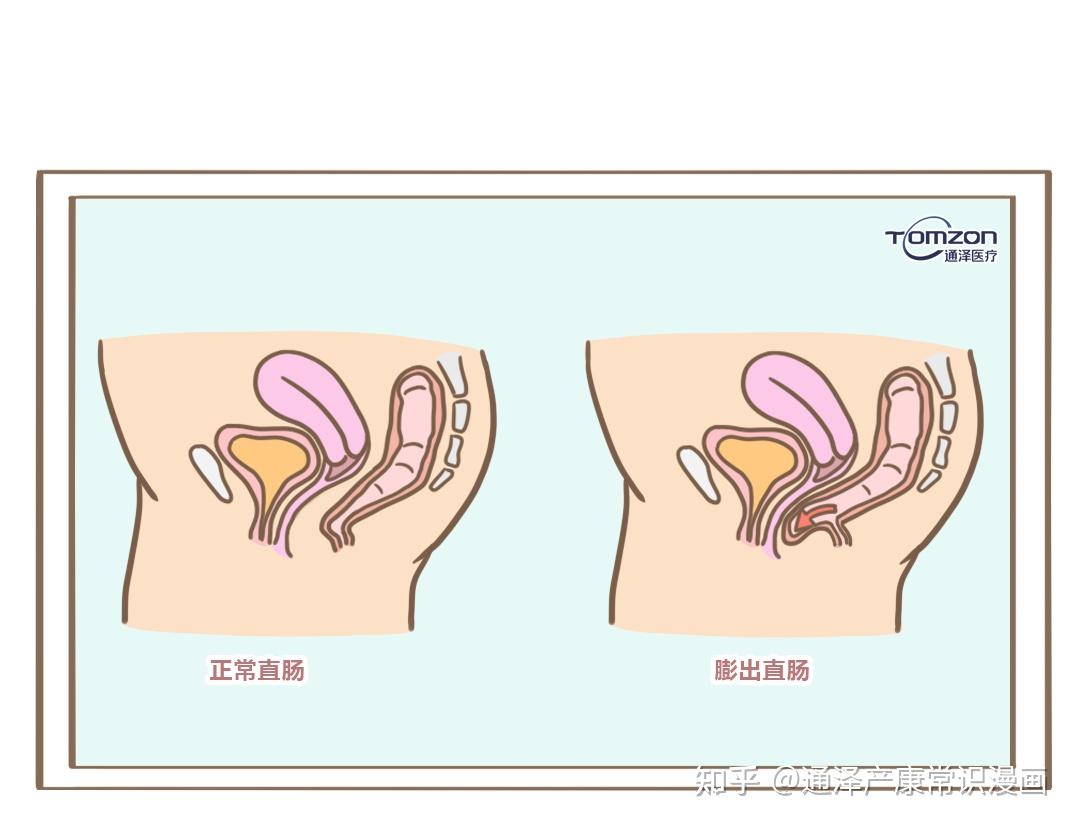 直肠膨出图片图片