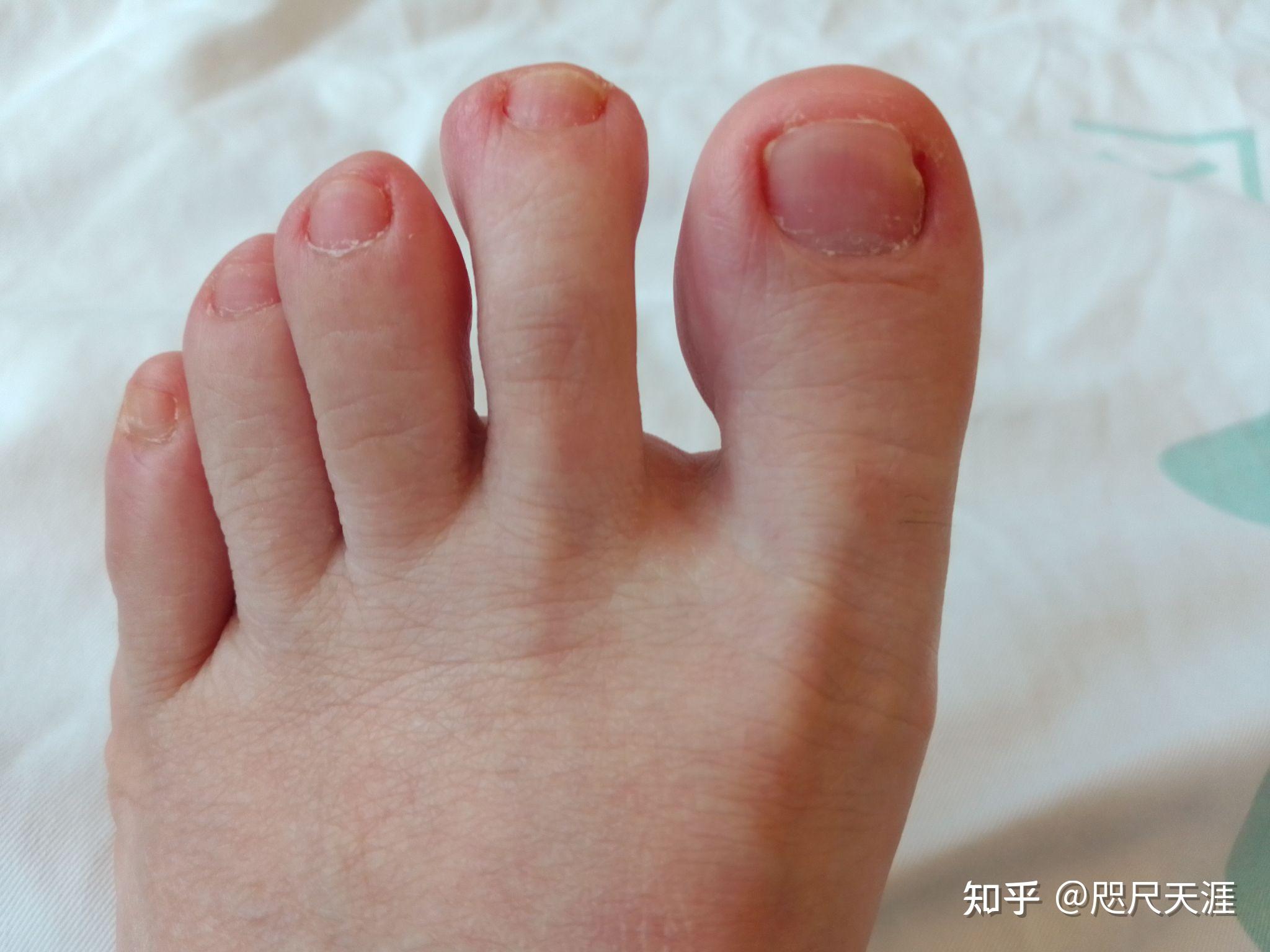 民间土方治疗灰指甲——不间断实践全治疗过程发图(100%原创真实不打