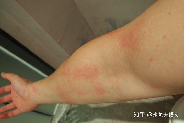 水土不服从过敏性鼻炎到荨麻疹的痛苦治疗之路