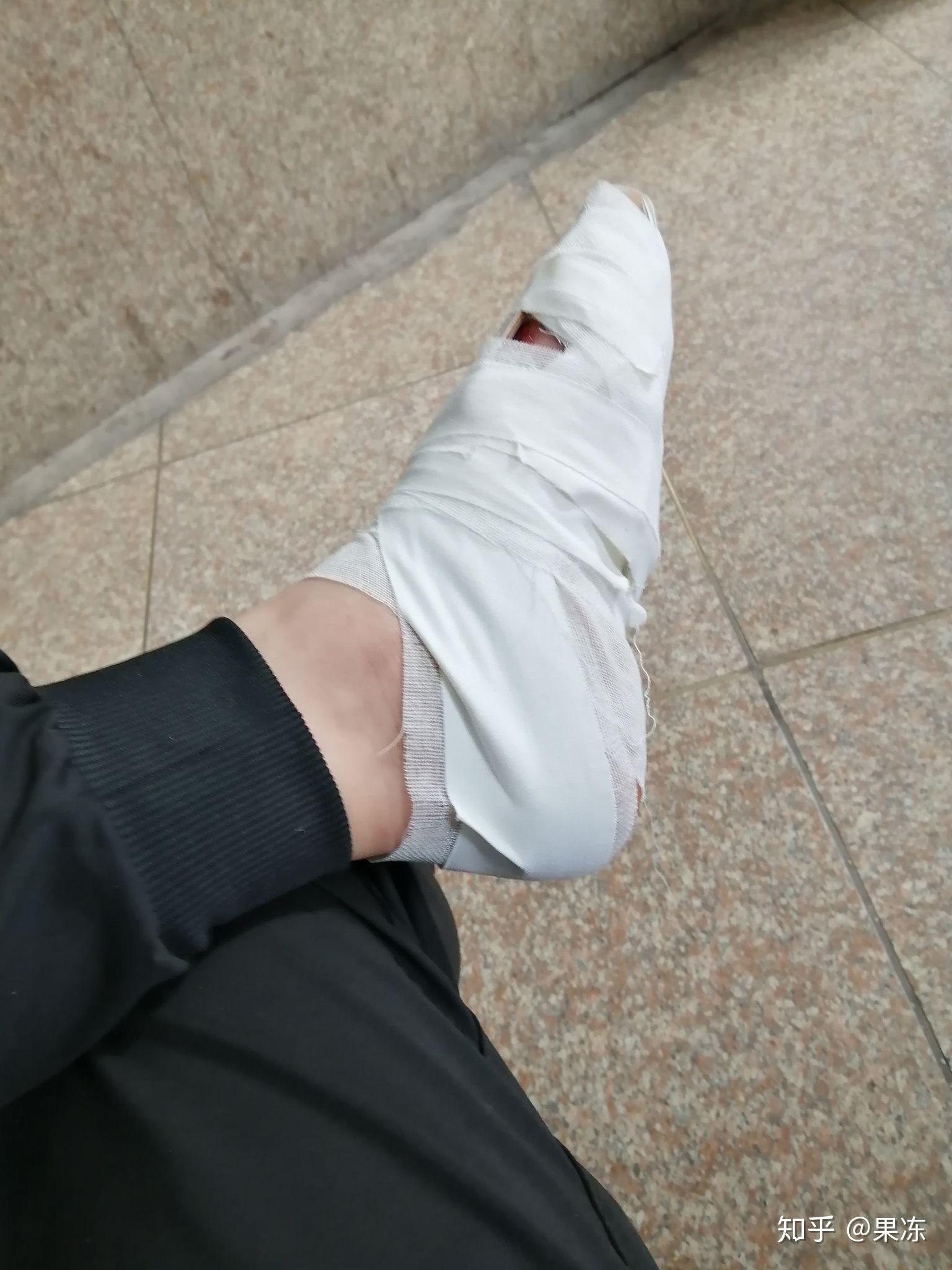 左脚第五跖骨骨折?
