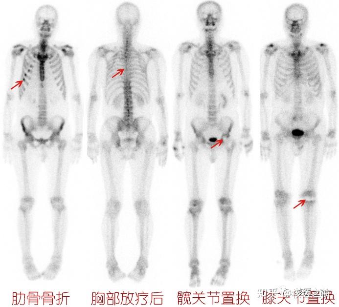 全身骨显像报告解读图片