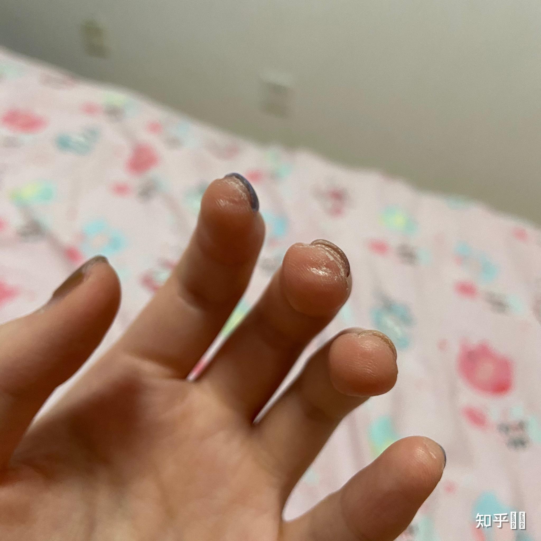 玩吉他的朋友可以拍一张左手手指上的茧吗