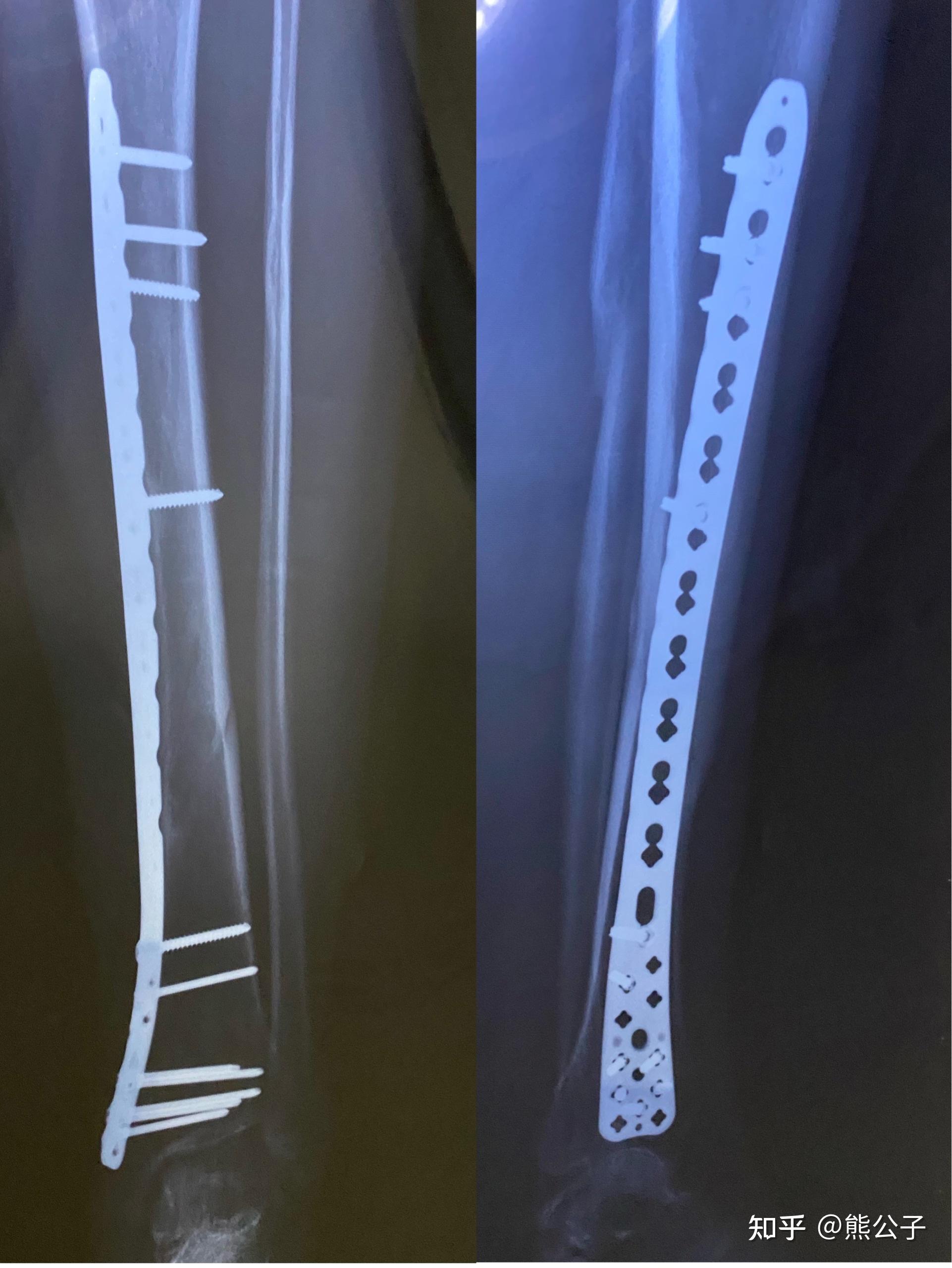 骨折取钢板的手术之后是什么感觉？ - 知乎