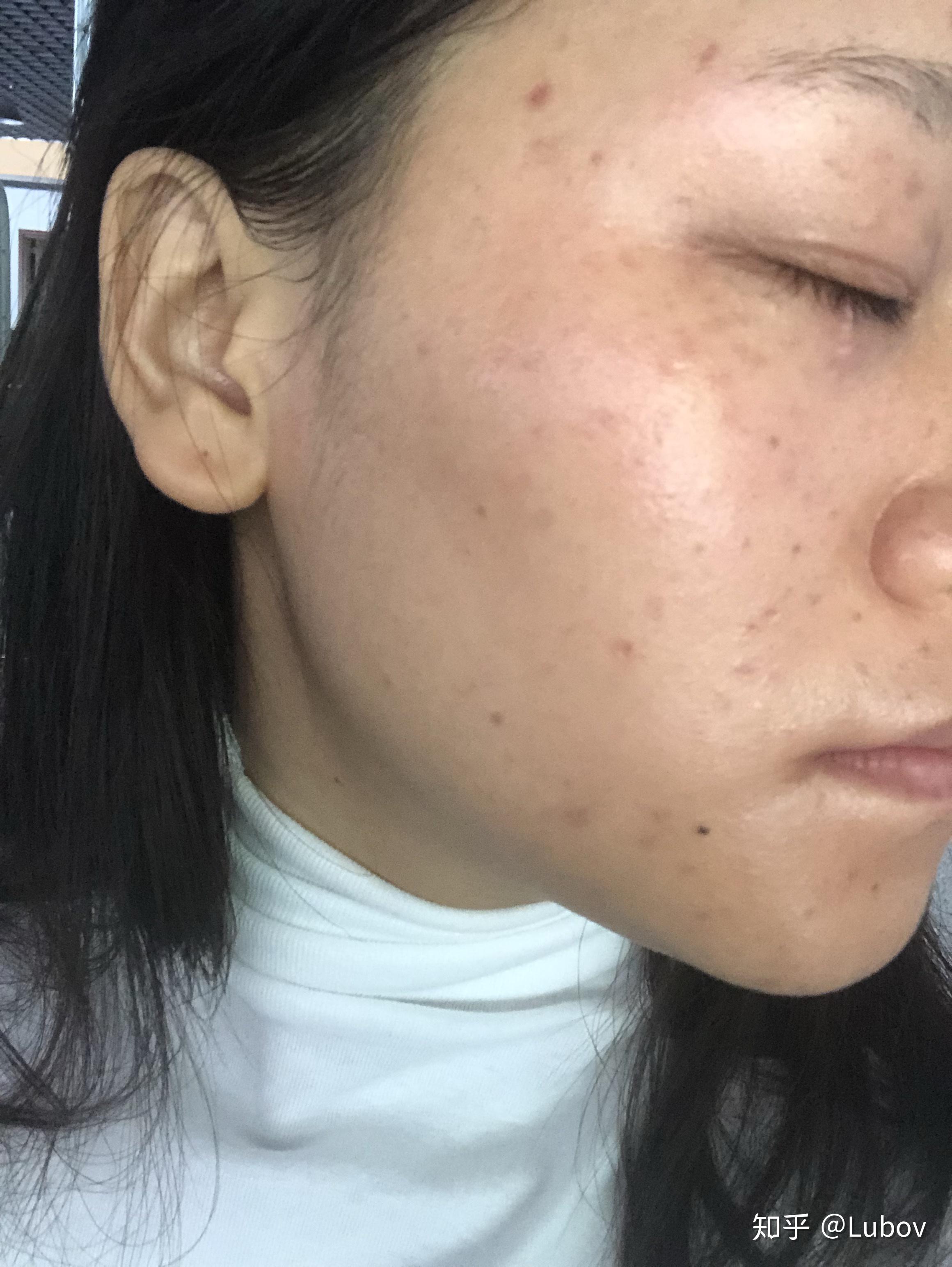 祛斑提取后,美容院说要用他家产品一年!感觉要吃土了 - 知乎