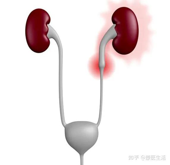 肾结石是什么原因造成的 知乎