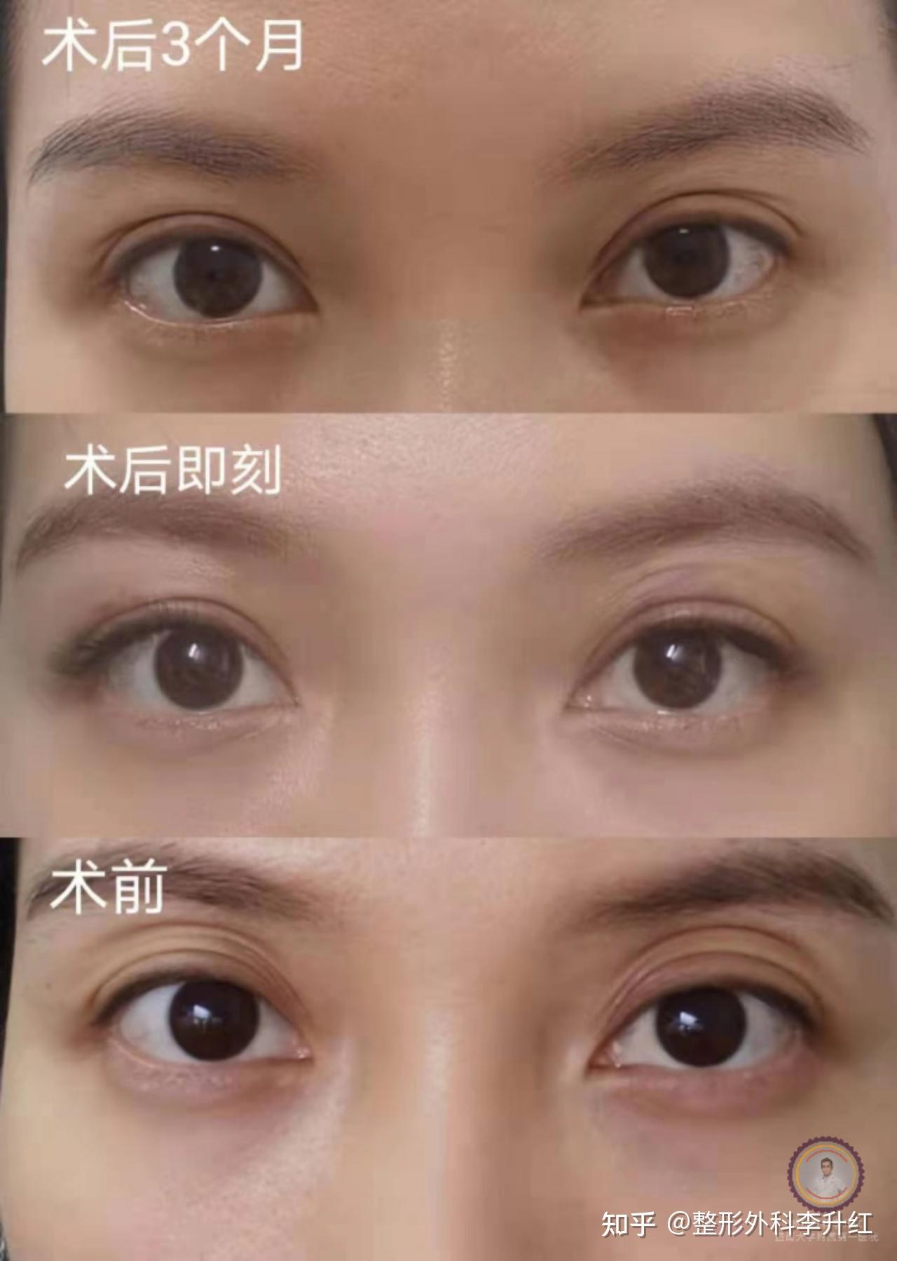 北京眼袋科普：祛眼袋后为什么有淤青？大概需要多长时间可消失？ - 知乎