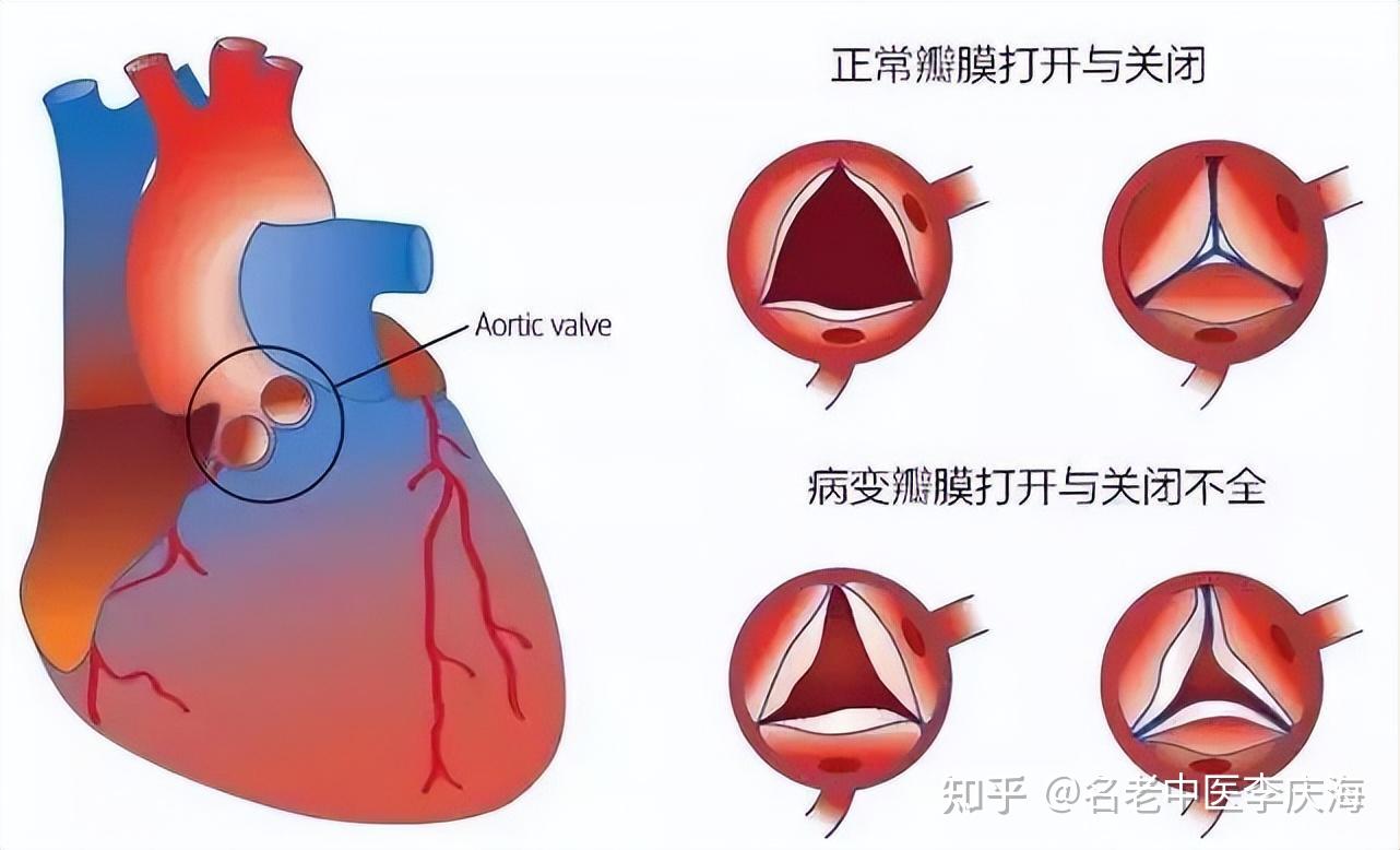 瓣膜脱垂图片