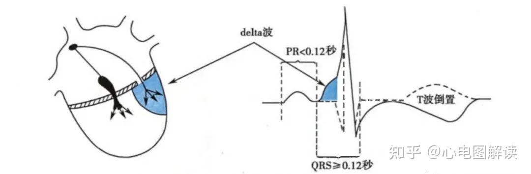 二,定位根据v1导联delta波极性及qrs主波方向可对旁路进行初步定位.