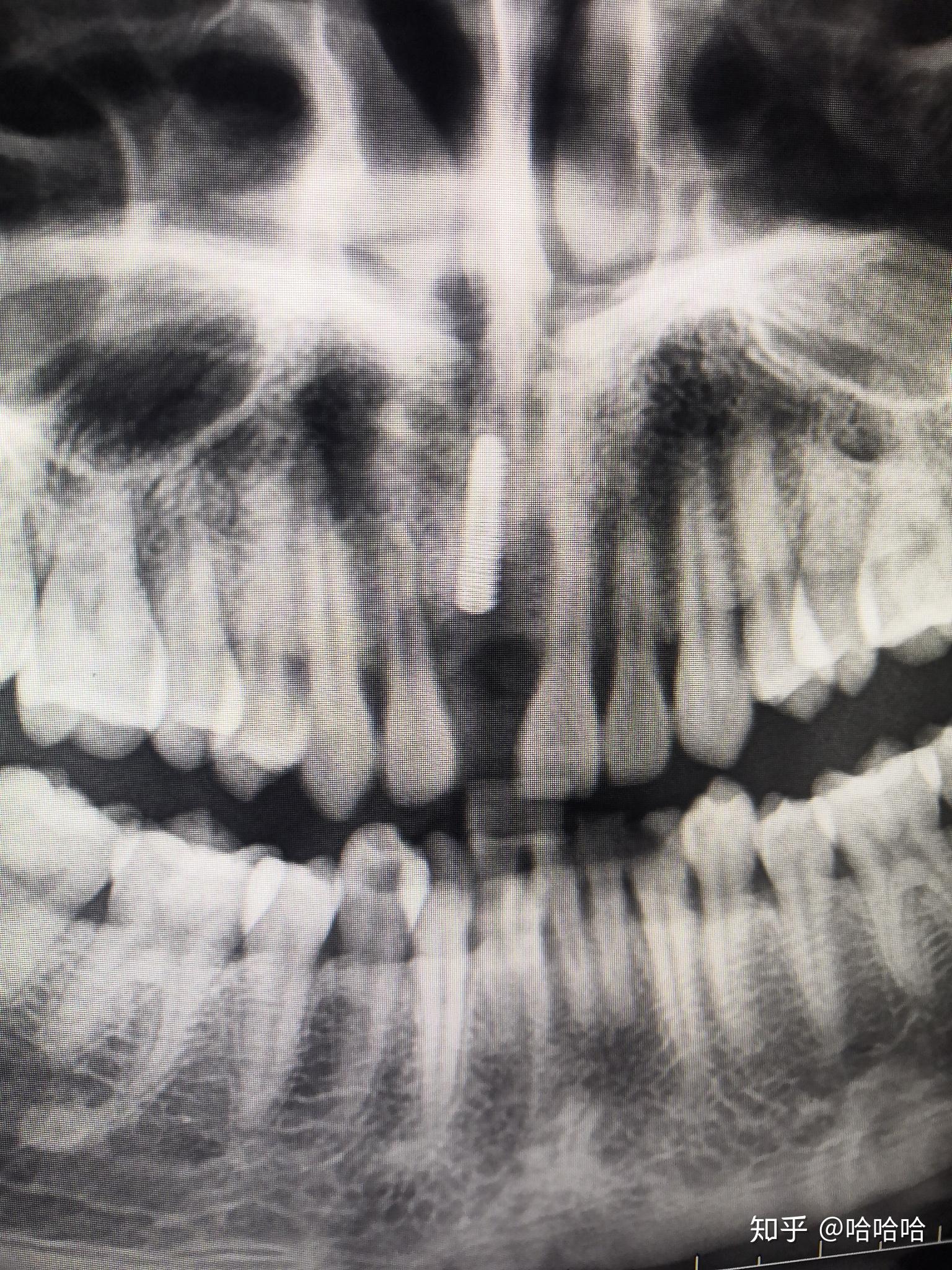 根尖囊肿是硬的吗? - 知乎