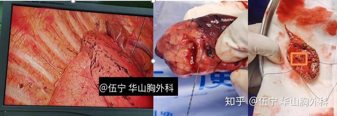 肺磨玻璃结节的治疗策略从最新的文献看ggo术前随访术中冰冻病理淋巴